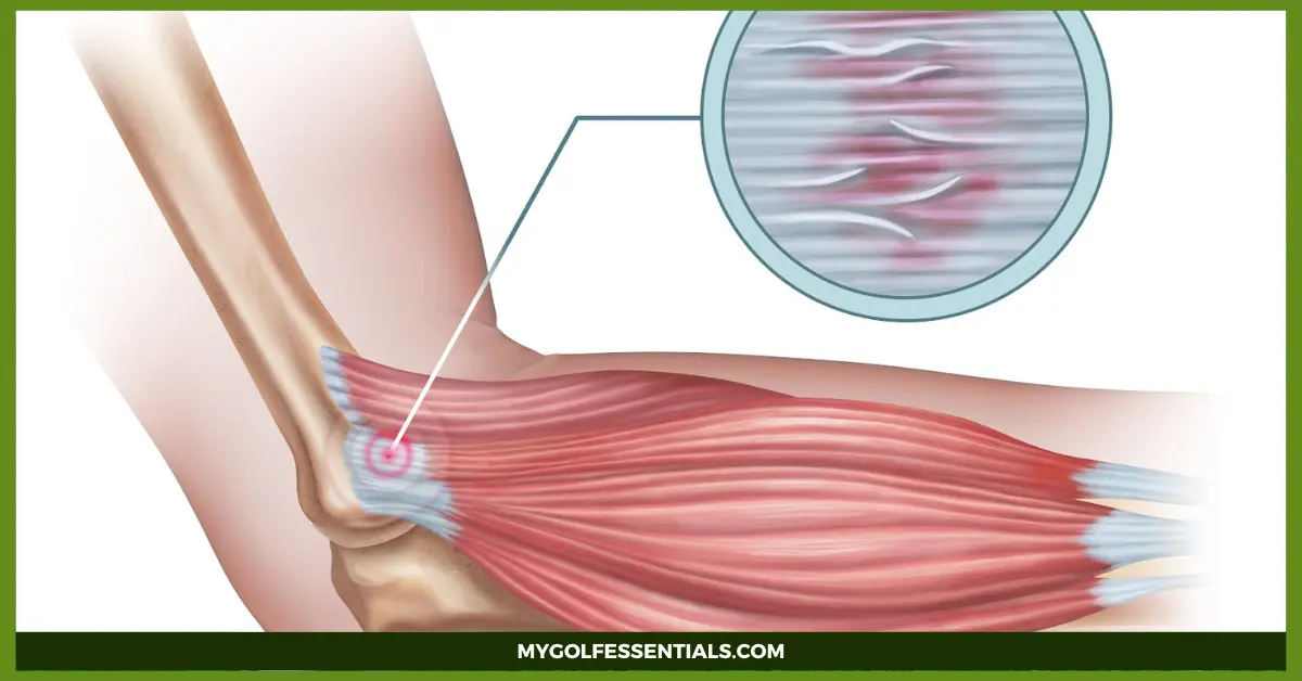 Tennis Elbow Exercises